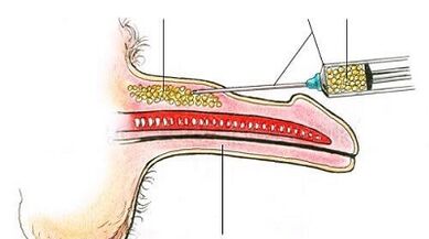 Surgery to increase members