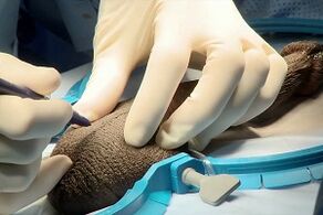 Midge incision for penis enlargement surgery