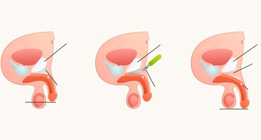 Ligamentotomy for Penile Enlargement