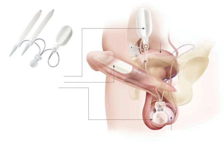 gel implant in penis